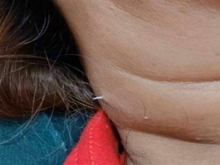 泰国女子吃鱼时被鱼刺扎穿脖子：医生直呼活久见！
